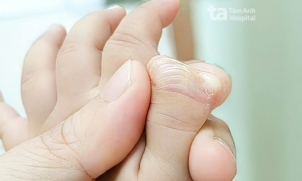 Bé gái có hai ngón cái trên một bàn tay