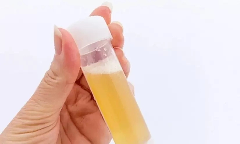 Đi tiểu nhiều bọt có phải suy thận?
