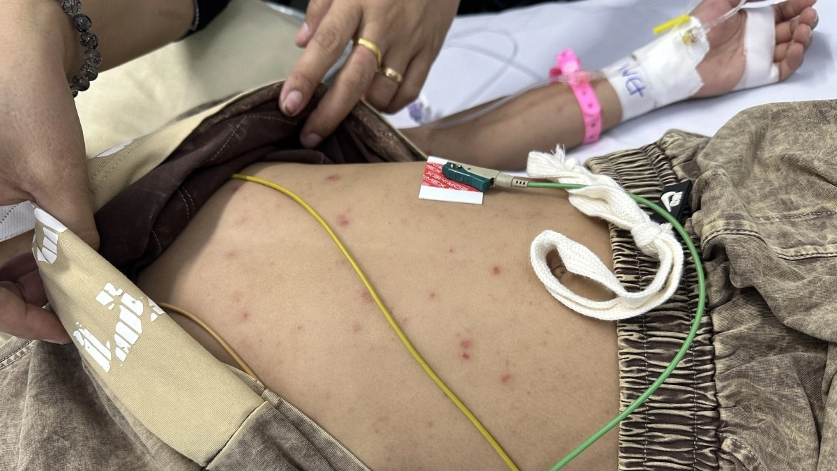 Trắc nghiệm: Phân biệt bệnh qua phát ban trên da