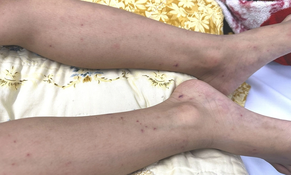Đường lây nhiễm của não mô cầu