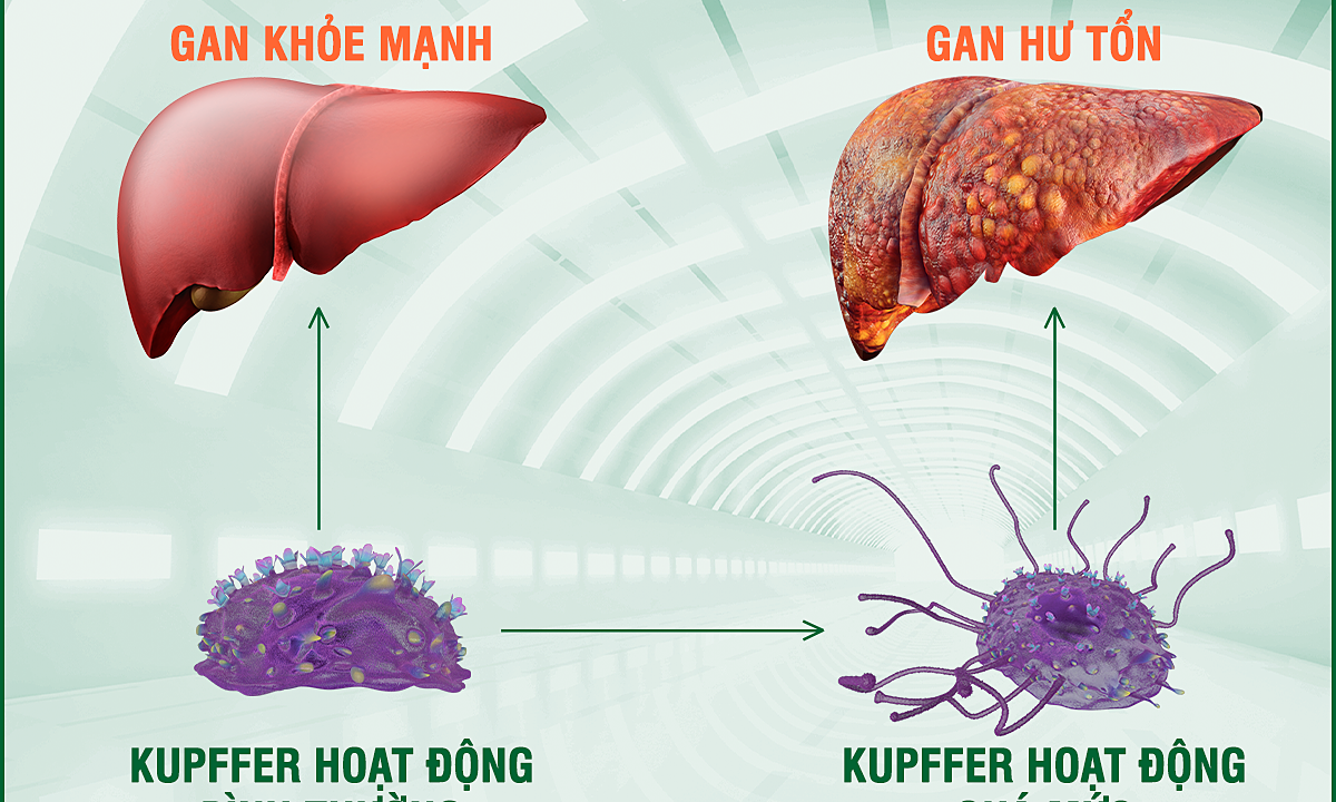 6 nguyên nhân gây tăng men gan thường gặp