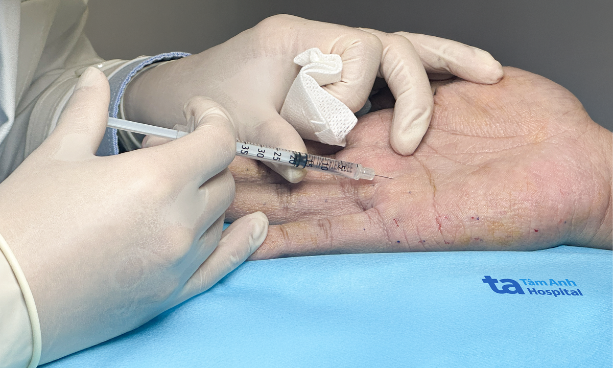 Giảm 70% mồ hôi tay sau một lần tiêm botox