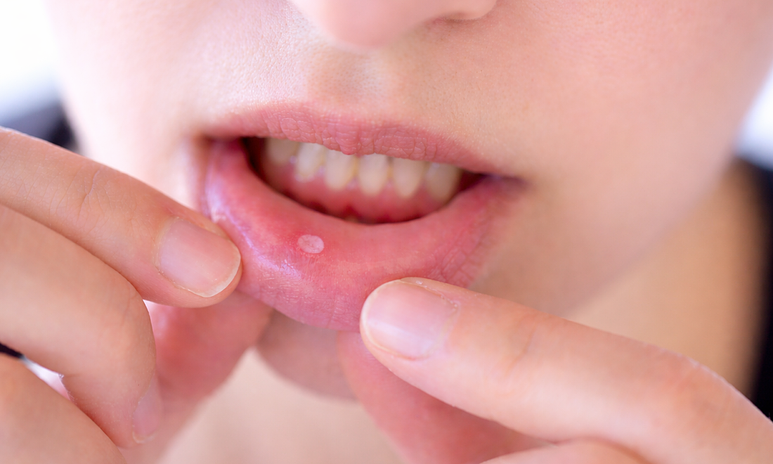 Vì sao không hút thuốc vẫn ung thư miệng?