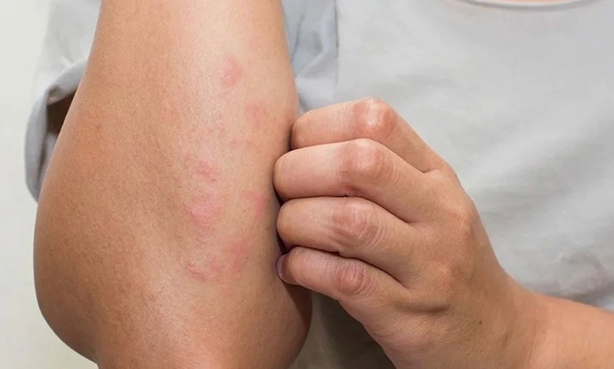 Dấu hiệu ngứa da có thể cảnh báo suy thận