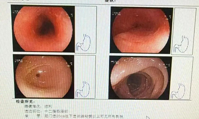Người phụ nữ loét thực quản 8 cm vì nuốt vội thức ăn trong nồi lẩu
