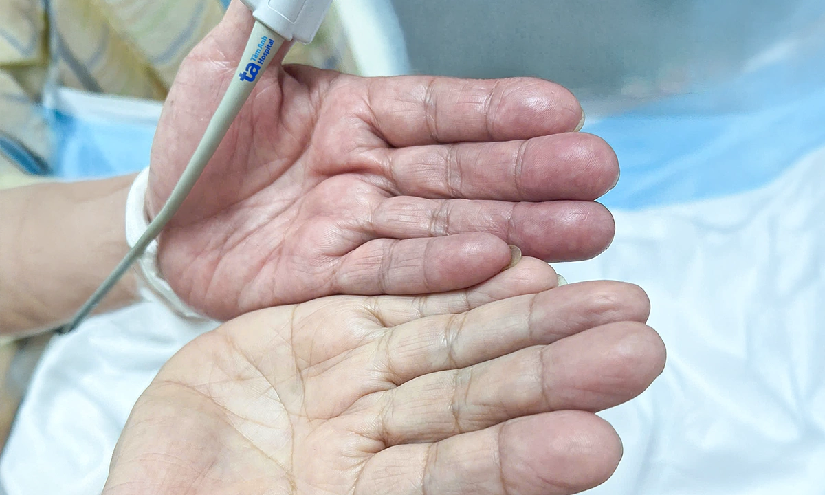 Huyết khối gây tắc động mạch cánh tay do bỏ thuốc chữa rung nhĩ
