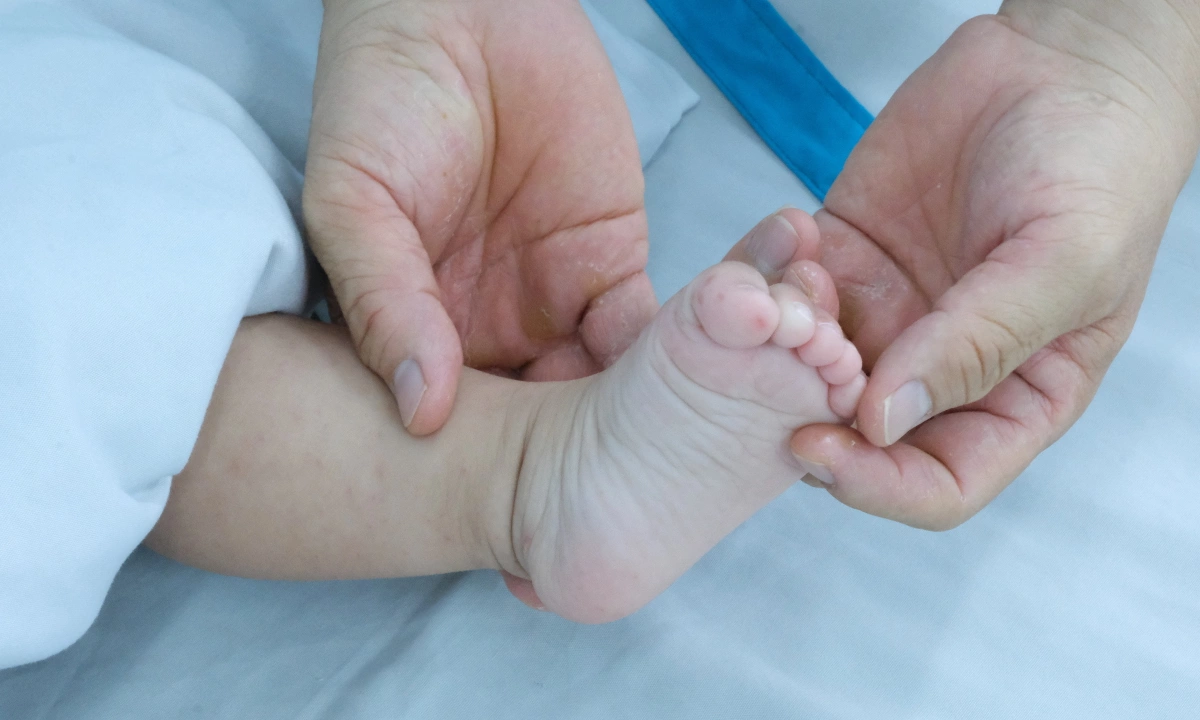Viêm não do tay chân miệng
