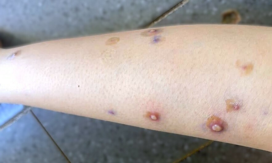 Lây chéo thủy đậu trong gia đình