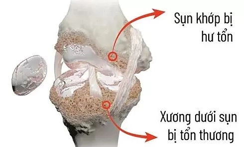 Vì sao khớp gối dễ bị thoái hóa?