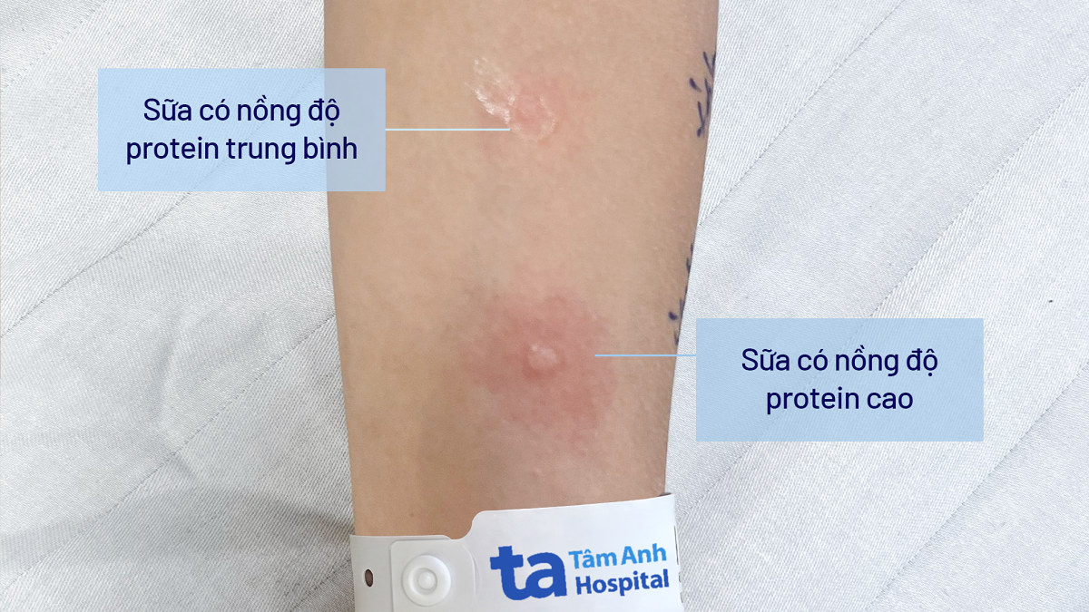 Bé trai mắc ba bệnh dị ứng