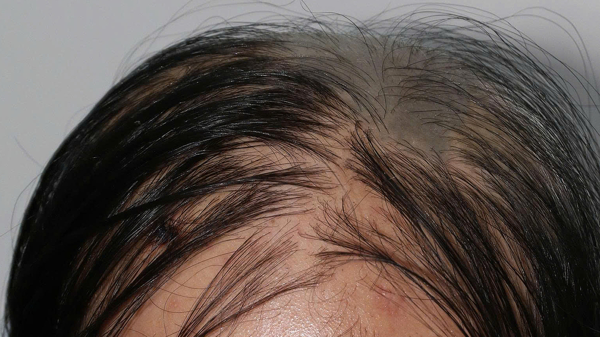 Cô gái mắc bệnh hiếm, rụng hàng trăm sợi tóc mỗi ngày