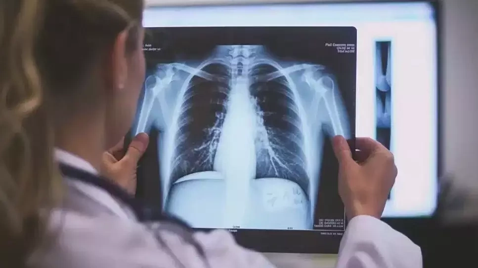 Vì sao không hút thuốc vẫn bị ung thư phổi?