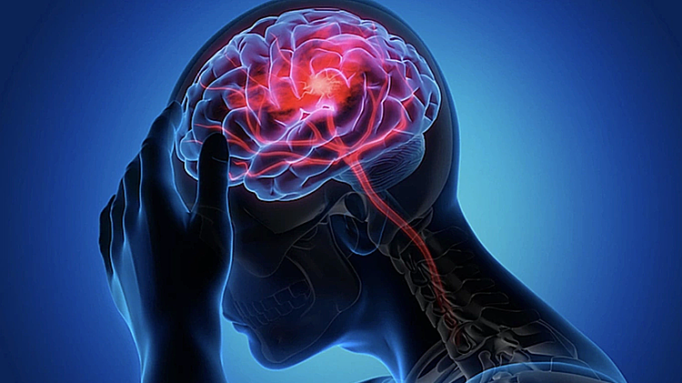 Tưởng đau đầu do nắng nóng hóa đột quỵ