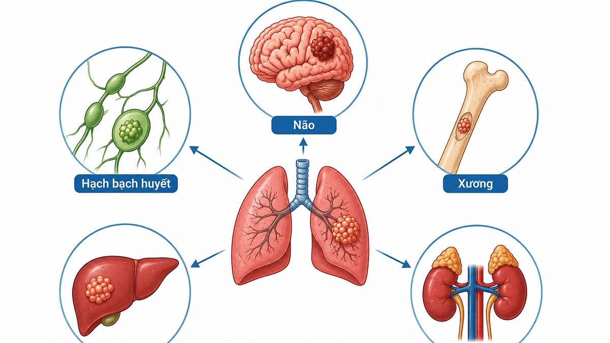 Ung thư phổi có thể di căn đến đâu?