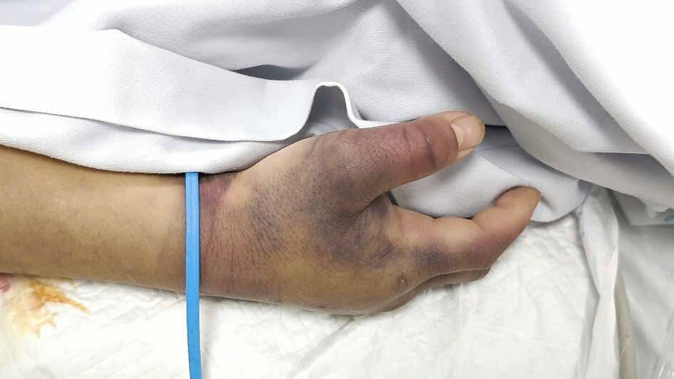 Ngất xỉu mới biết mắc sốt xuất huyết