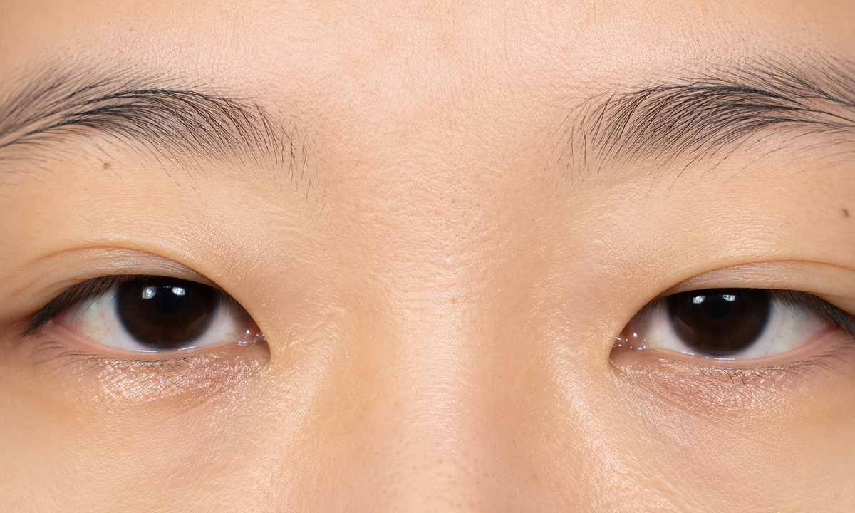 Hội chứng mí mắt mềm