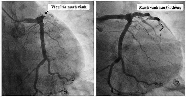 Nhồi máu cơ tim tuổi 25