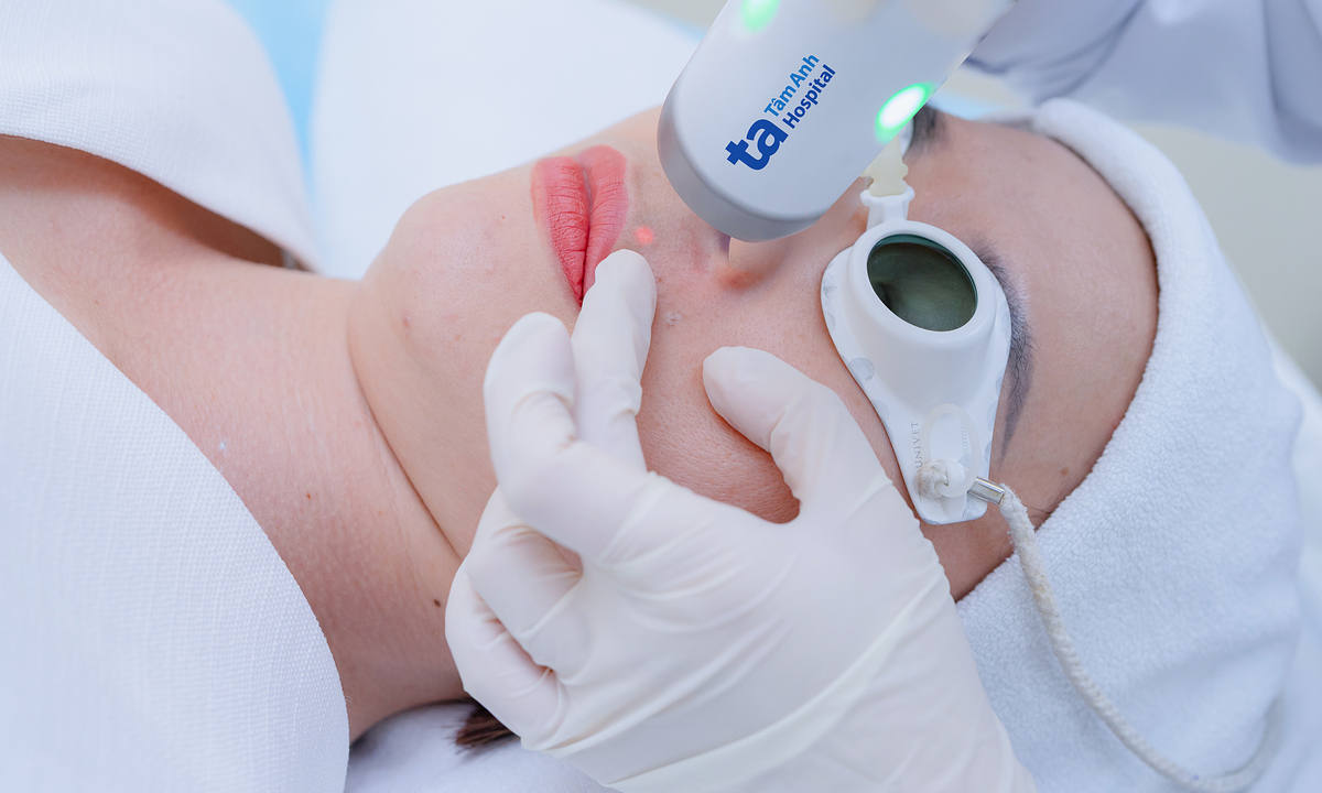 Điều trị giãn mao mạch bẩm sinh bằng laser được không?