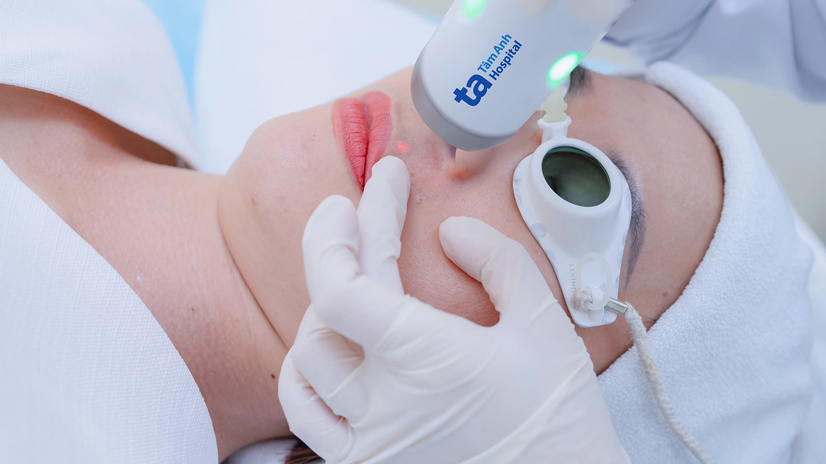 Điều trị giãn mao mạch bẩm sinh bằng laser được không?