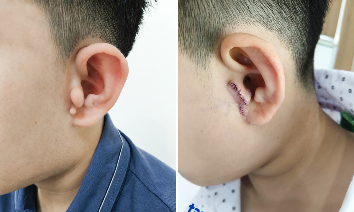 Bé trai bị dị tật vành tai bẩm sinh