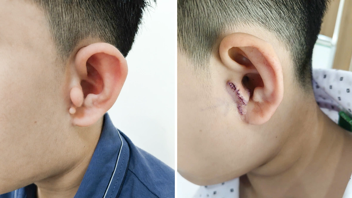 Bé trai bị dị tật vành tai bẩm sinh
