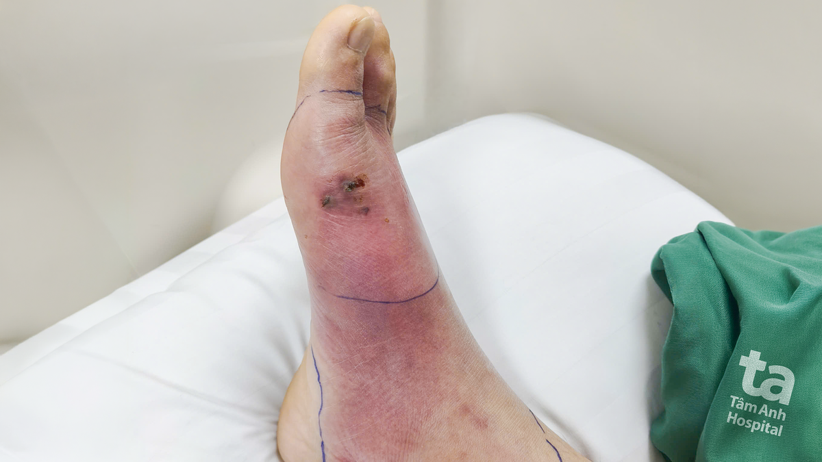 Nhiễm liên cầu khuẩn từ vết thương nhỏ ở chân