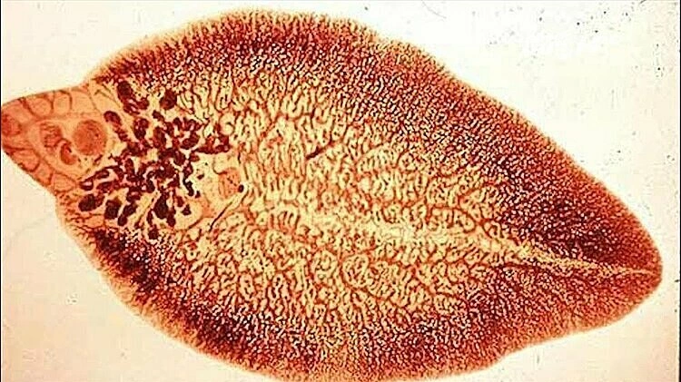 Uống 80 viên thuốc trị giun sán, người phụ nữ suýt mất lá gan