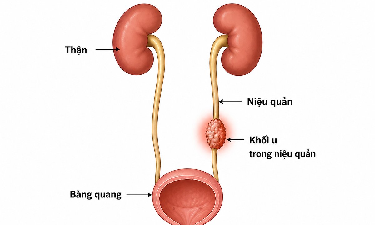 Ung thư niệu quản