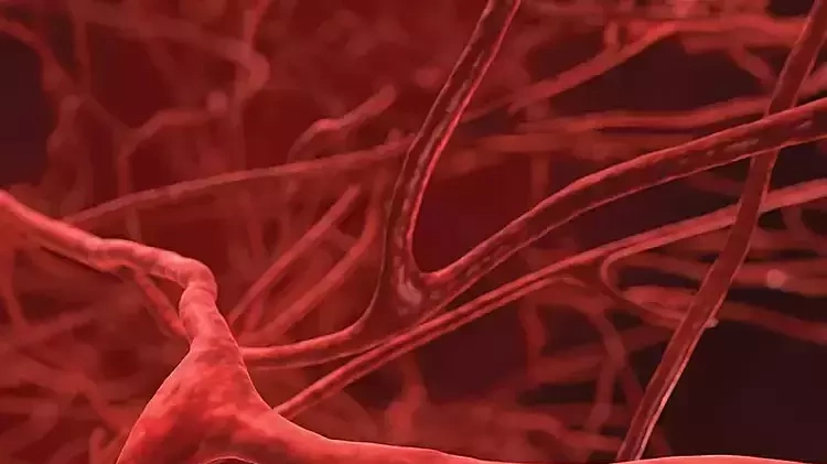 Tưởng bị tiền đình hóa phình mạch máu não