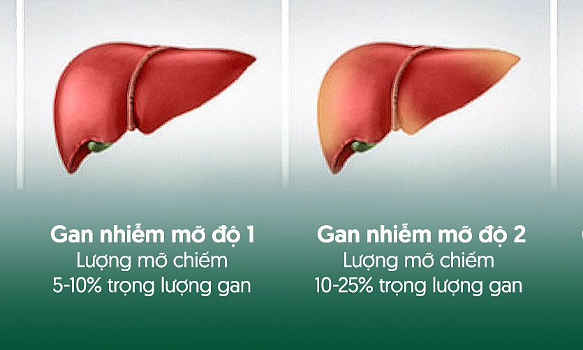 Tiến trình gan nhiễm mỡ