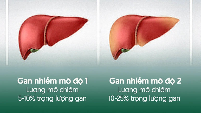 Tiến trình gan nhiễm mỡ