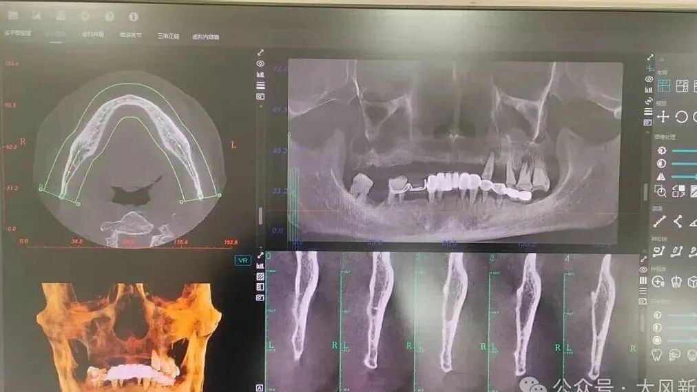 Người đàn ông đi khám chiếc răng đau nhưng bị nhổ cả hàm