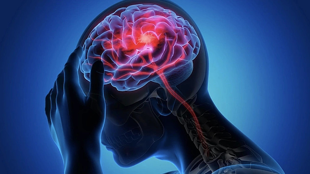Đột quỵ vẫn đi làm bởi nghĩ 'phải bất tỉnh mới bệnh'