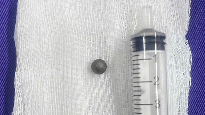 Bé trai bị bi sắt đâm xuyên mắt, nằm sát nền sọ