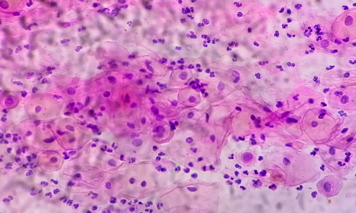 5 bệnh ung thư vùng mũi, miệng liên quan HPV