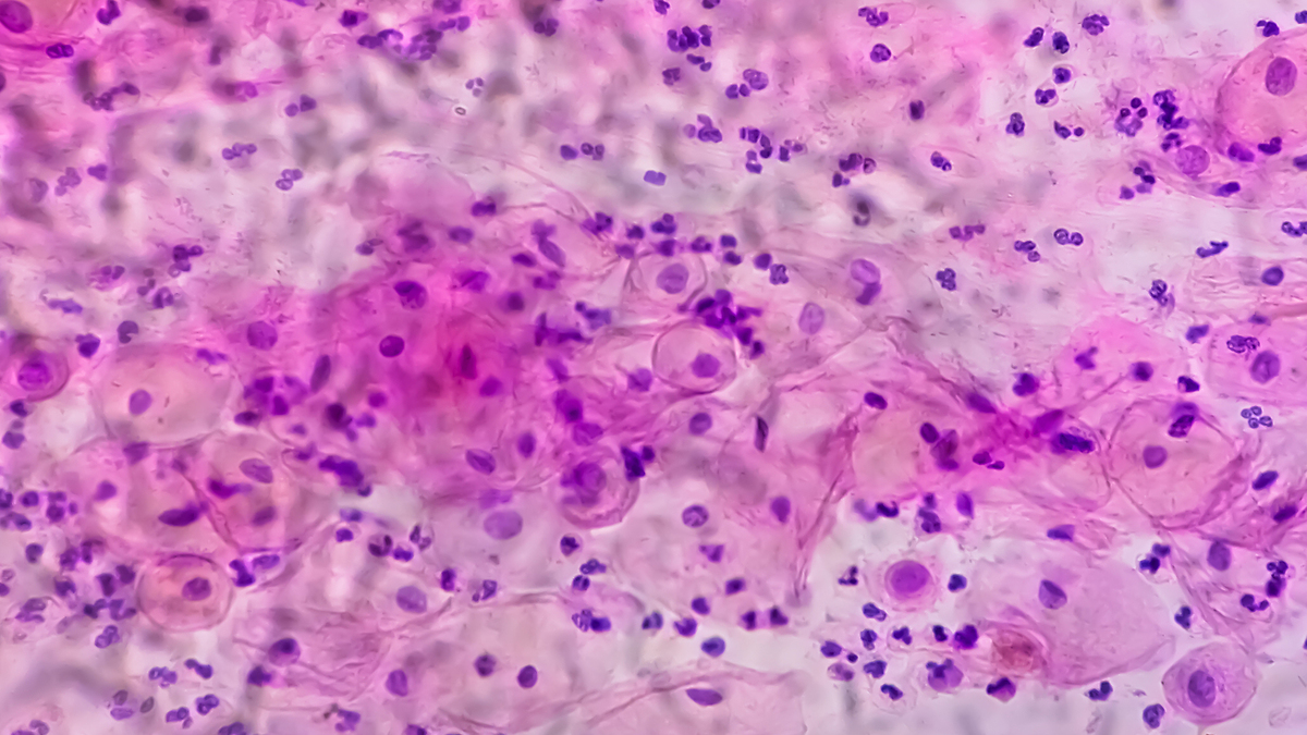 5 bệnh ung thư vùng mũi, miệng liên quan HPV