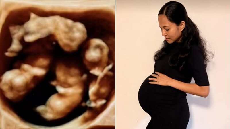 Ca sinh 4 cùng trứng tự nhiên, tỷ lệ 1 trên 15 triệu