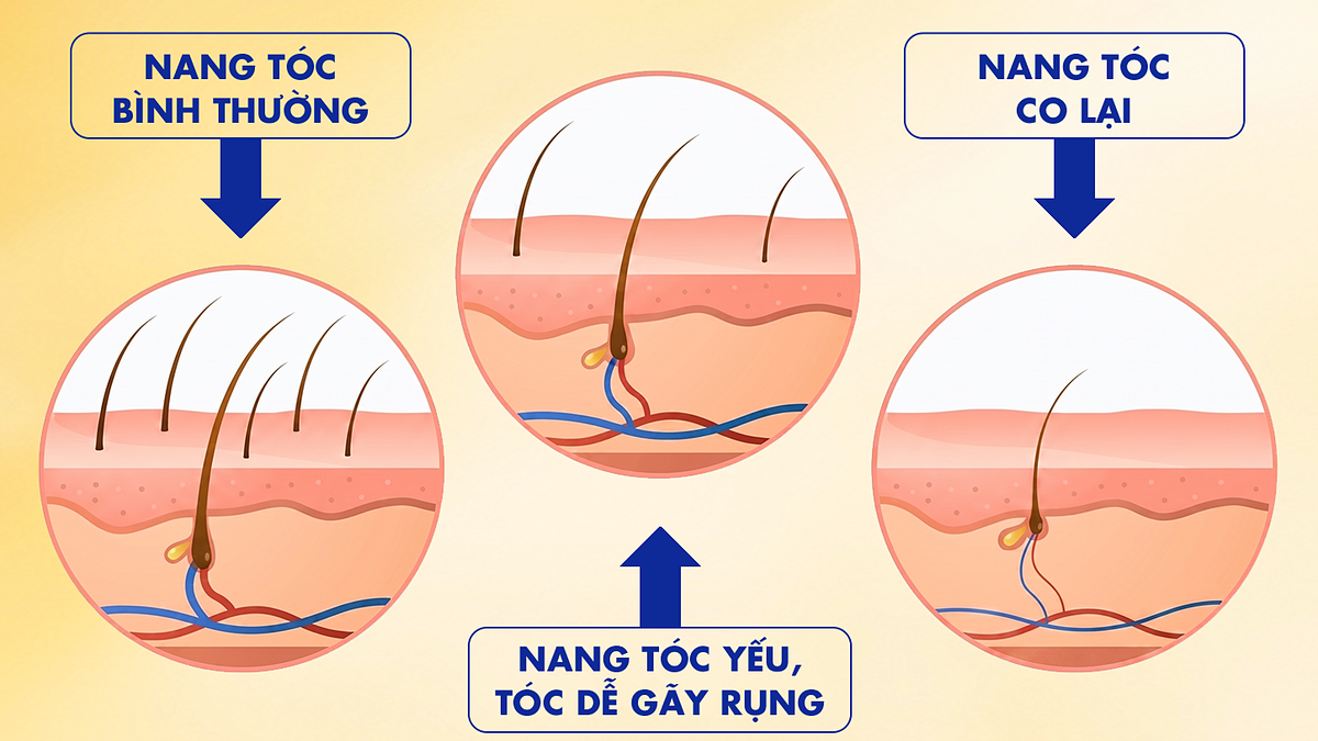 Nhuộm tóc có khiến tóc rụng nhiều hơn?