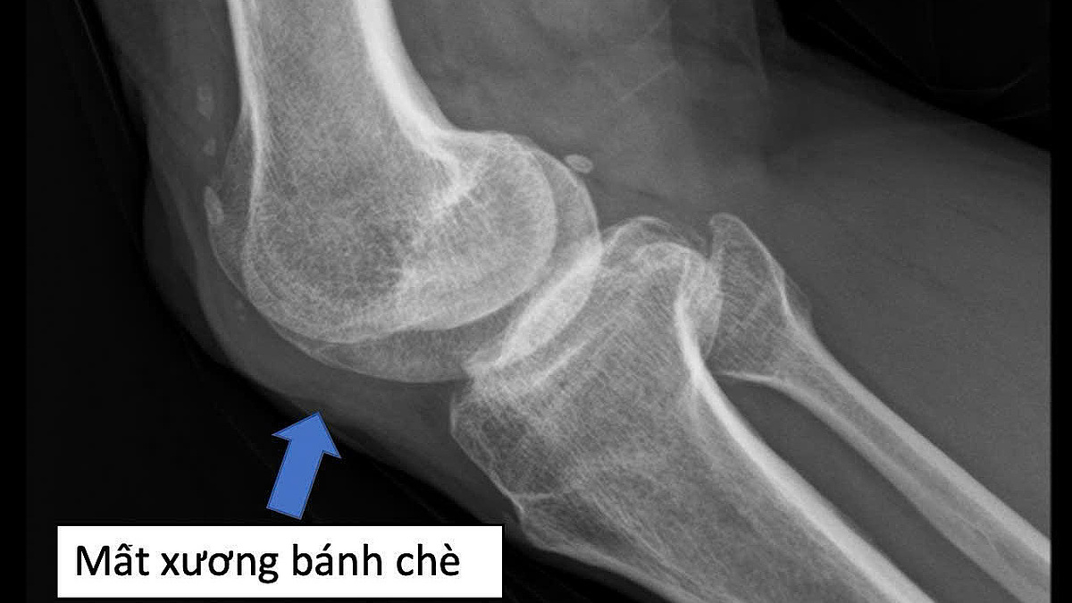 Nối mạch cứu đôi chân thương binh mất xương bánh chè nửa thế kỷ