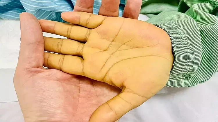 Viêm gan A, B, C, D, E lây nhiễm và hại cơ thể thế nào
