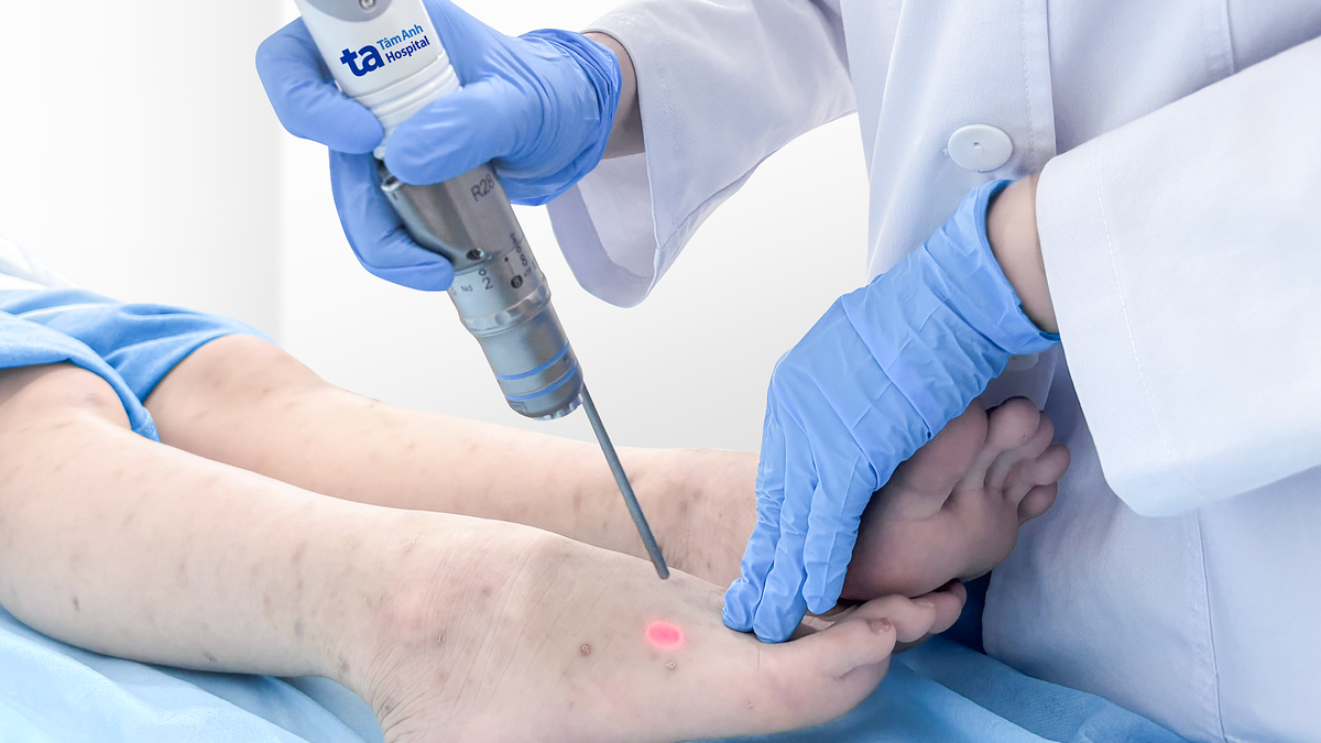 Điều trị tăng sắc tố da bằng laser