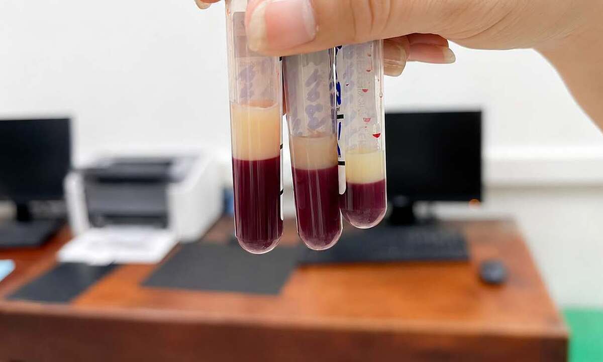 Huyết tương đục như sữa ngay khi vừa lấy máu