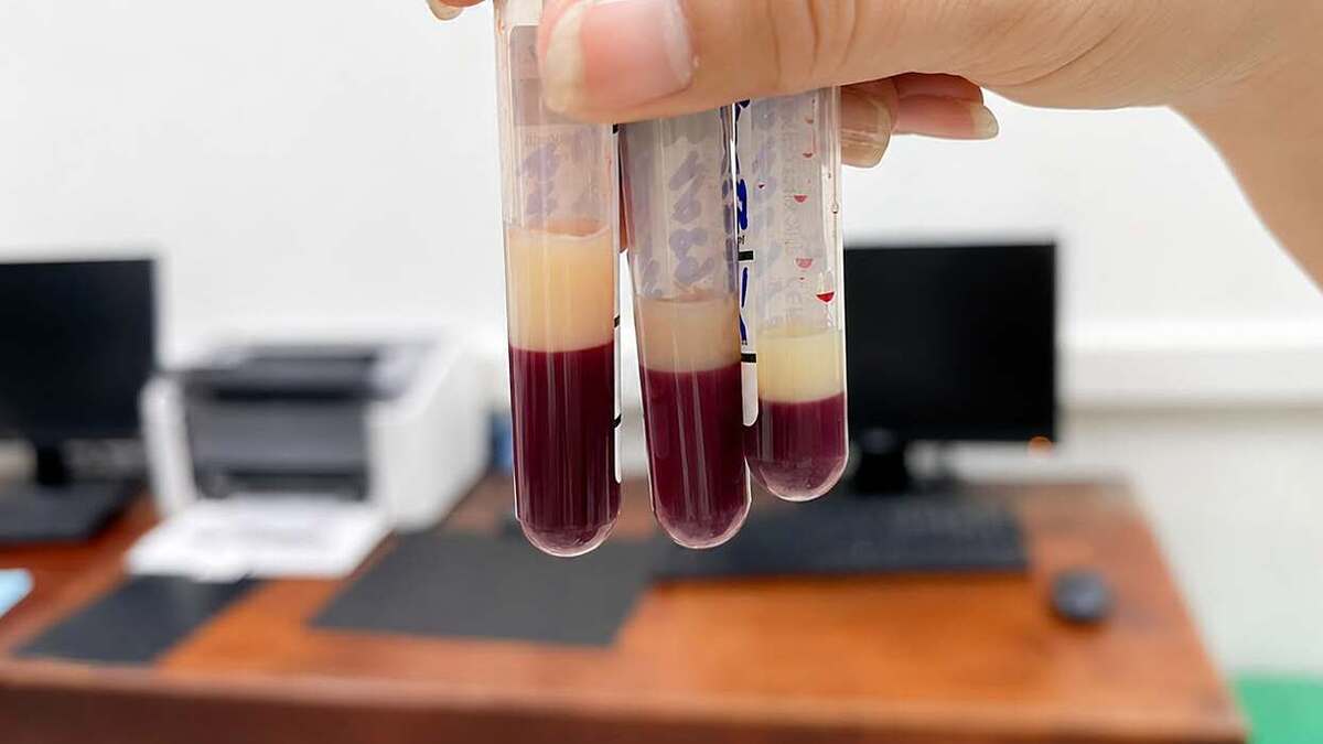 Huyết tương đục như sữa ngay khi vừa lấy máu