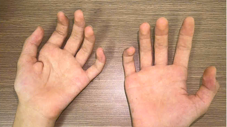 Thiếu niên bị teo cơ bàn tay bởi bệnh thần kinh ở nam giới trẻ