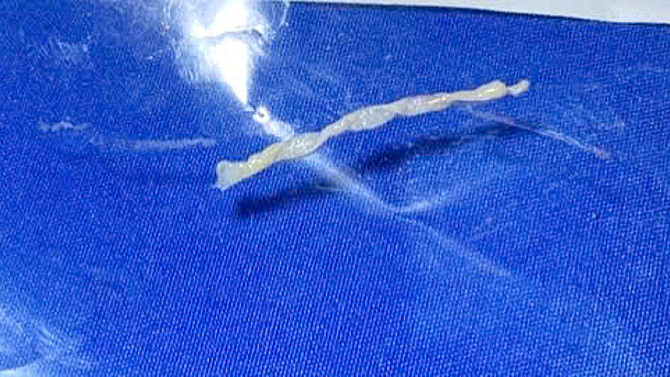 Bị sán nhái dài 7 cm ký sinh dù không ăn đồ tái, sống