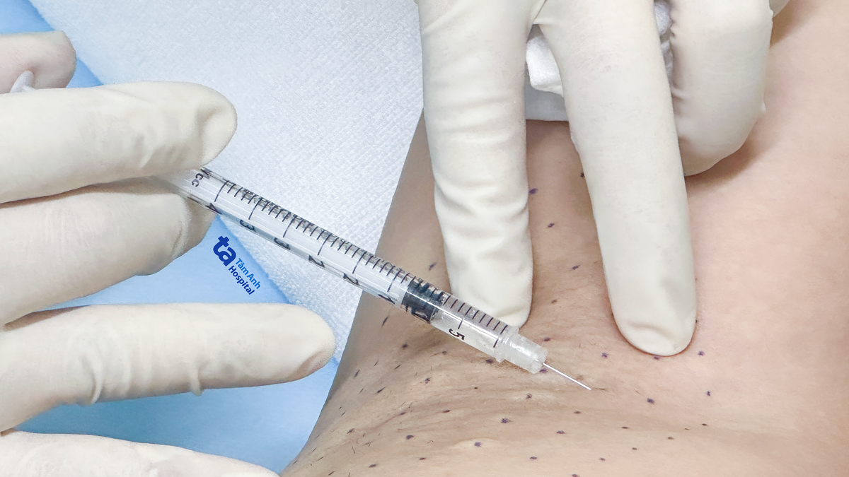 Tiêm botox trị mồ hôi nách sau sinh