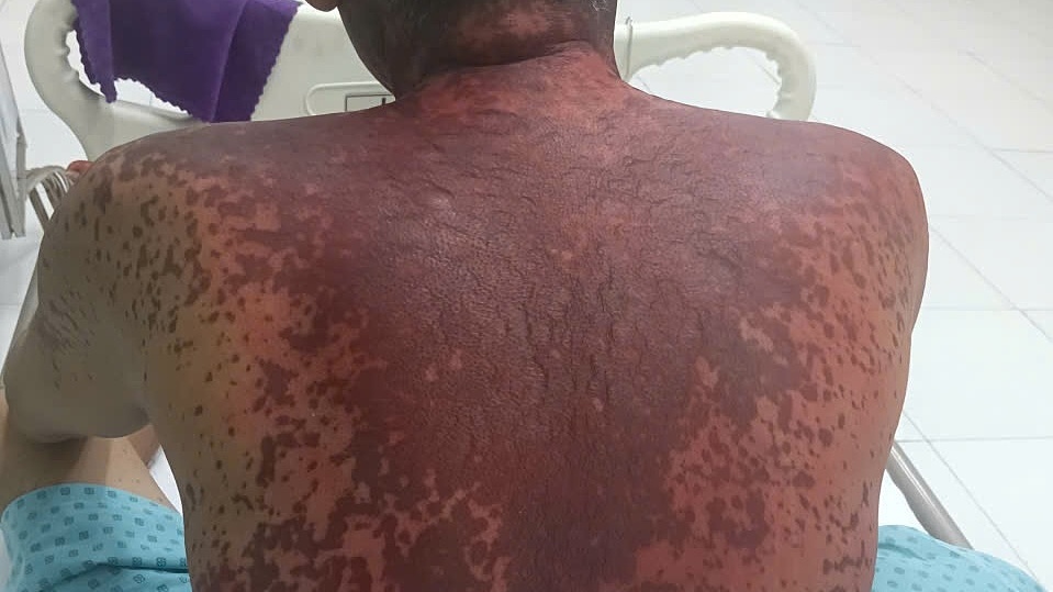 Nhiễm độc do dị ứng thuốc nhỏ mắt