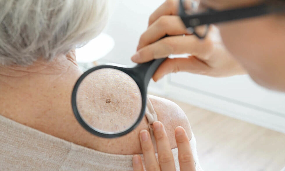 Bác sĩ khuyến cáo dấu hiệu ung thư da dễ nhầm với mụn nhọt