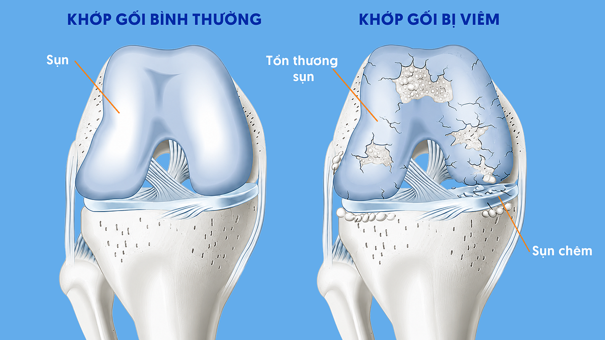4 bệnh xương khớp thường gặp do thoái hóa sụn