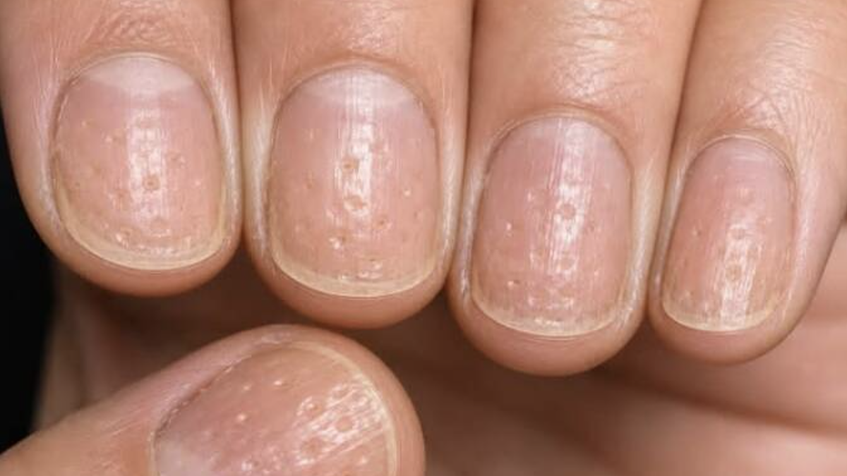 Dấu hiệu bất thường trên móng tay cảnh báo bệnh tiềm ẩn